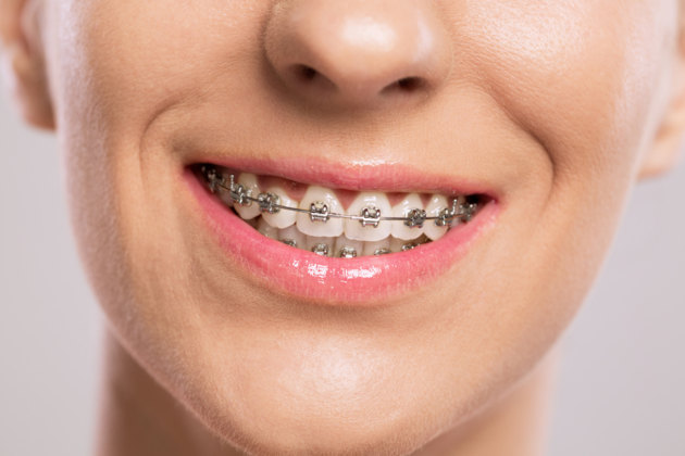 Orthodontie, les adultes s’y mettent aussi